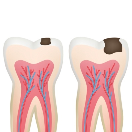Animated tooth in need of pulpotomy to repair