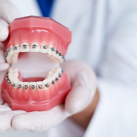Gloved hands holding dental model with traditional braces