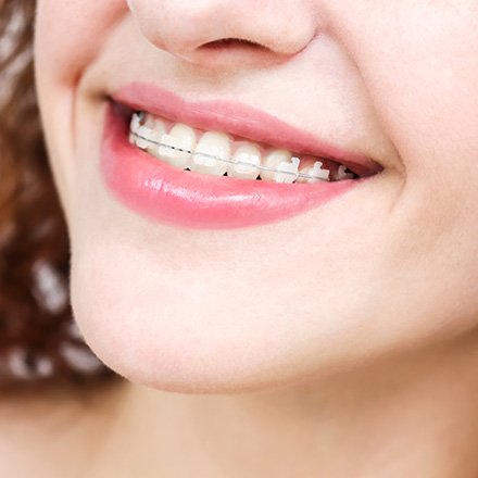 Close-up of woman’s smile with clear ceramic braces