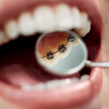 Mirror in patient’s mouth, showing lingual braces