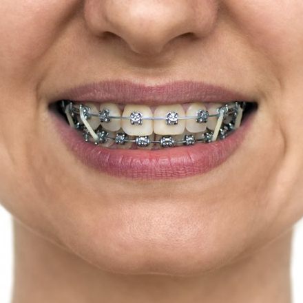 Close-up view of traditional braces and rubber bands