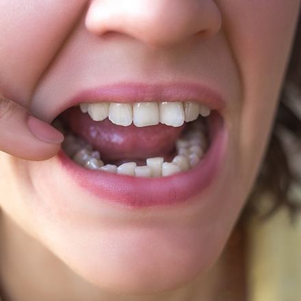 Woman pointing to her lower arch of overcrowded teeth
