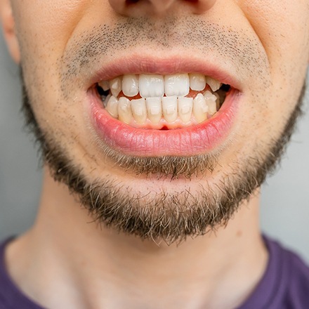 Nose-to-neck view of man smiling with clear aligners with attachments