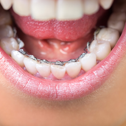 Braces located on the backside of teeth