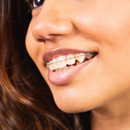 Up-close view of clear braces