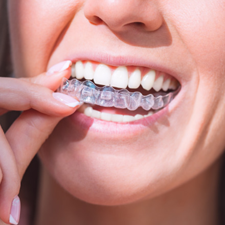 Person inserting clear aligner into the mouth