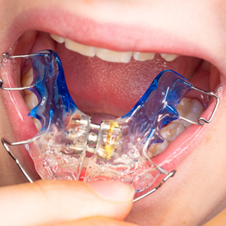 Patient inserting a retainer into their mouth