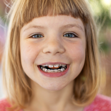 Little girl smiling with oral appliances on her teeth