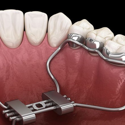Illustration of palatal expander attached to teeth
