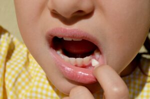 Nose to chin view of a child pulling lip to reveal loose tooth