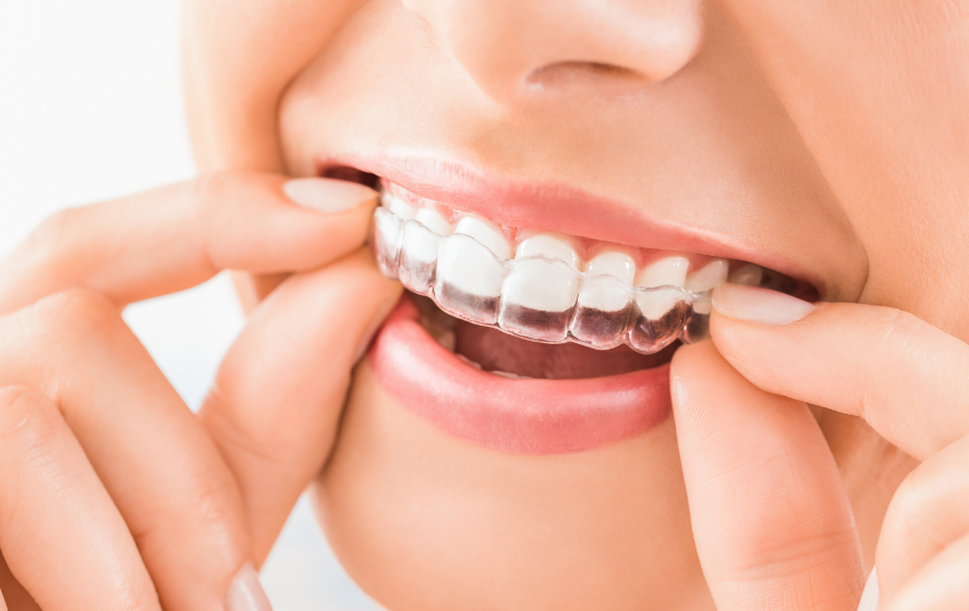 Woman with clear aligner on teeth